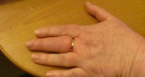 кольцо на отёкшем пальце