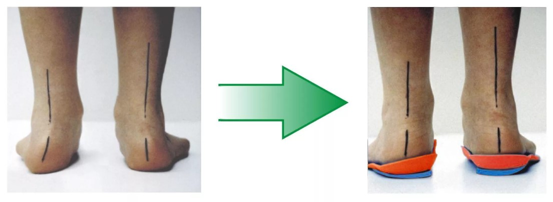 Какую обувь носить при плоскостопии: какая обувь способствует развитию  плоскостопия?
